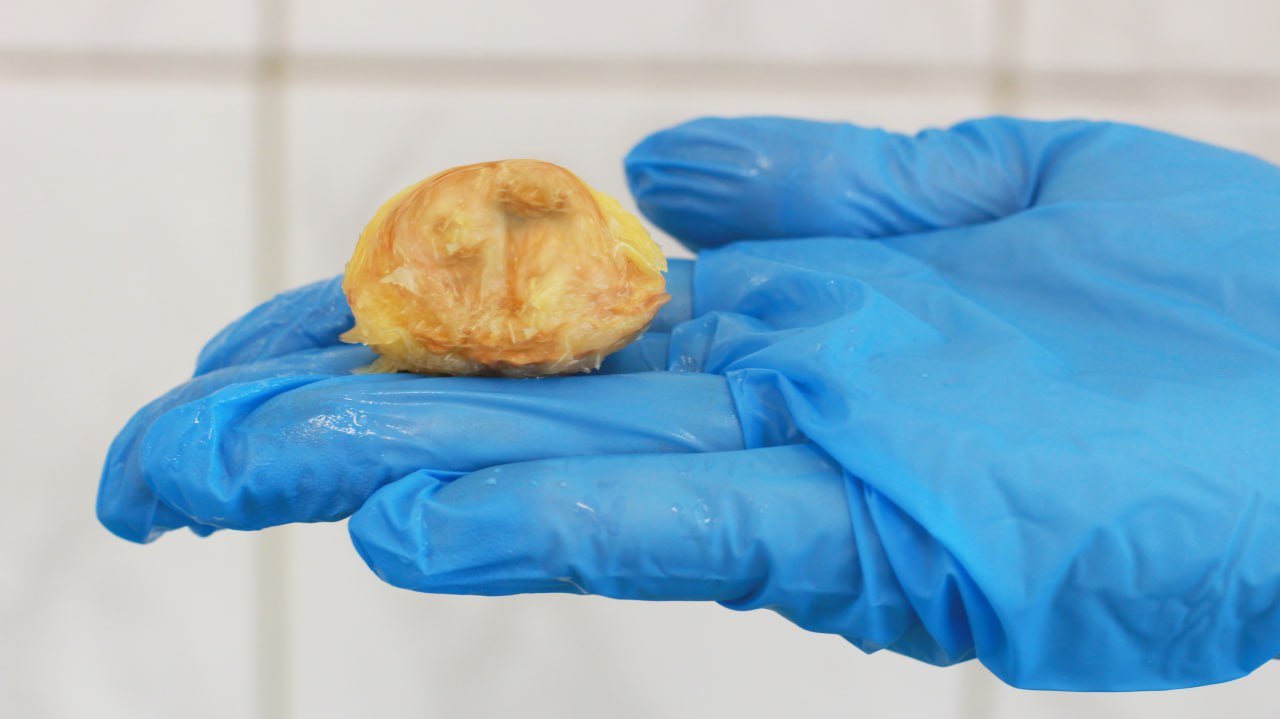 В Сергиево-Посадской больнице врачи спасли мужчину, проглотившего косточку от персика